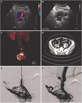 Clinical Features and Endovascular Management of Iliac Arteriovenous Fistulas: A 10-Year Single Center Experience